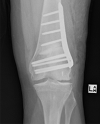 distal femoral osteotomy hardware removal